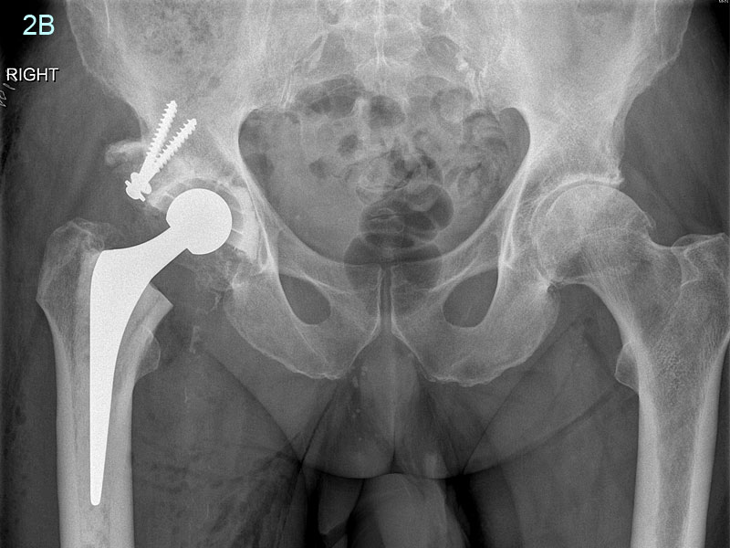 image showing GC Radiographs show collapse of the femoral head (Ball) and migration of the hip out of the acetabulum (Socket) causing damage to it. Requiring the need to put a bone graft in the acetabulum to reconstruct the socket