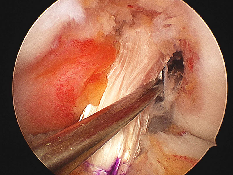 Knee Sports Injury – Anterior Cruciate Ligament (ACL)