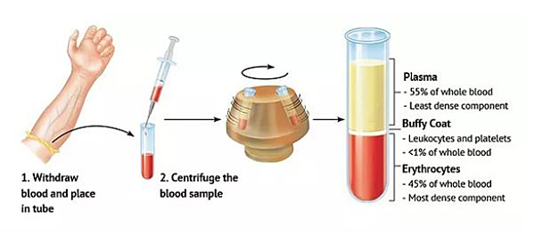 Principles of PRP Preperation Consultant hip and knee surgeon Mr Aslam Northwest Hip knee clinic uses the Arthex ACP System of preparation of PRP