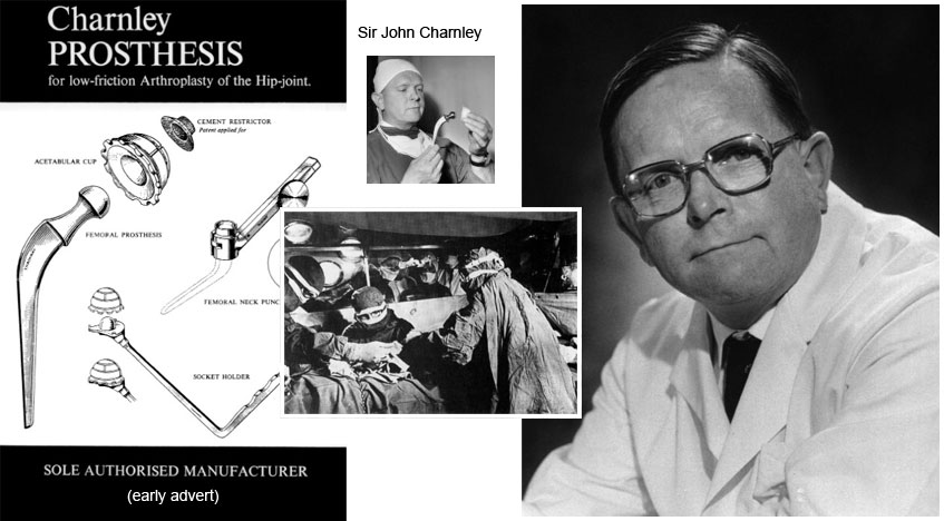 Hip replacement Historyadvanced in the 50's by Sir John Charnley
