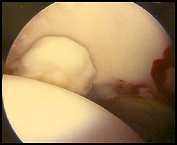 hip arthroscopy images picture showing loose fragments of bone in the hip joint  consulatant hip surgeon Mr Aslam Mohammed world renkown hip and knee surgeon