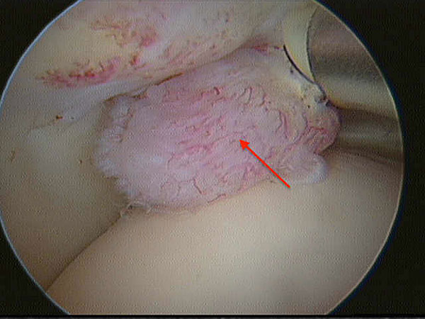 image showing PVNS in a 42 yr old female with unexplained  hip pain