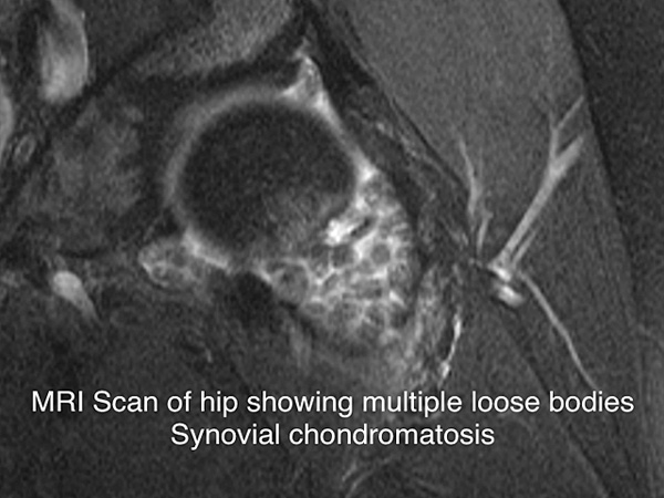 MRI scan showing multiple loose bodies MRI scan showing multiple loose bodies in a hip
