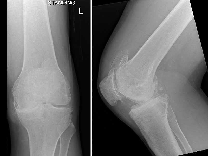 image showing 48 year old male knee arthritis and bowing of the leg due to a earlier total meniscetomy in patient teenage years