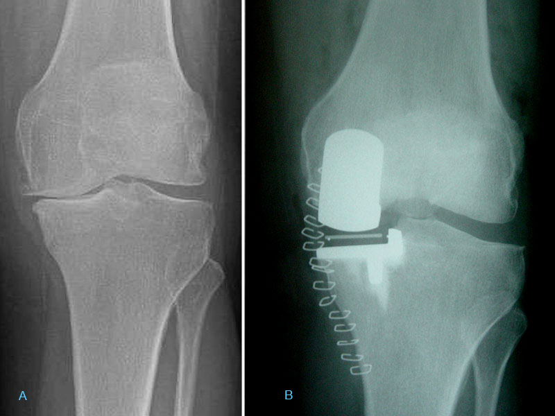 image showing knee arthritis partial knee  replacement by consultant surgeon Mr Aslam Mohammed