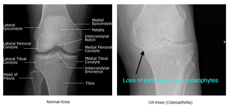 image showing anatomy of the knee a normal healthy knee the other image shows knee arthritis a loss of joint space and osteophytes