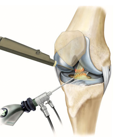 knee arthroscopy telescope examination of the knee joint