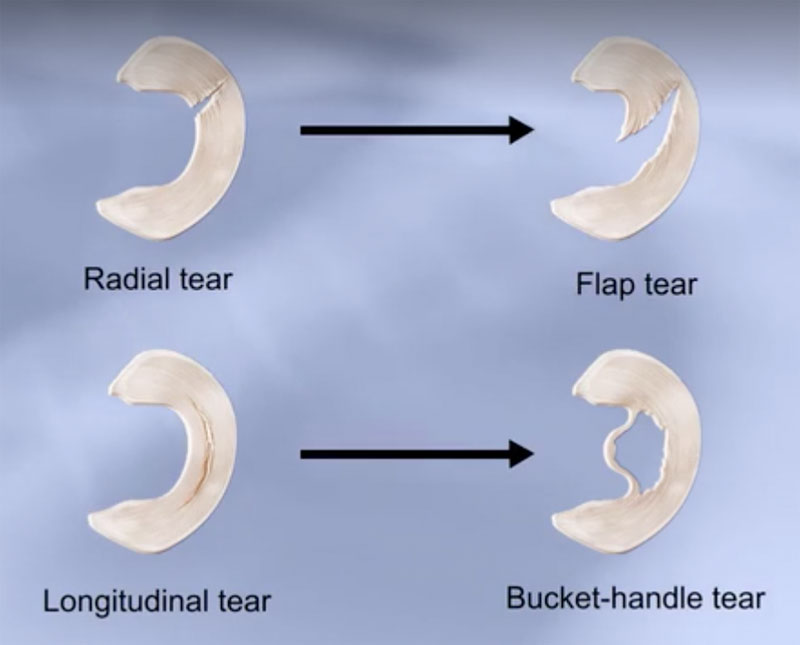 Meniscal Tear Types